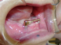  １  インプラント植立後、義歯の維持力を高めるためにアタッチメント（磁石）を装着。