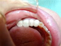 奥歯の治療　術後