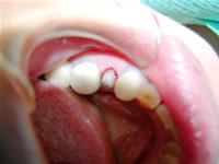 奥歯の治療　術前
