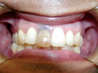 前歯の変色　術前