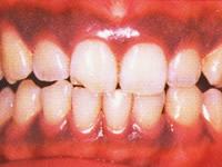 歯茎の色　術前