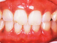 歯茎の色　術後